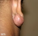 keloid