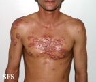 keloid