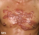 keloid
