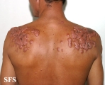 keloid