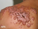 keloid