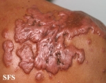 keloid