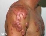 keloid