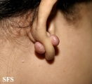 keloid