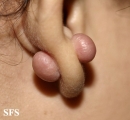 keloid