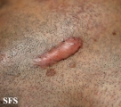 keloid