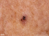 basal cell carcinoma