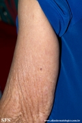 basal cell carcinoma