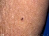 basal cell carcinoma