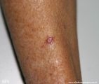 basal cell carcinoma