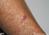 basal cell carcinoma
