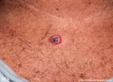 basal cell carcinoma