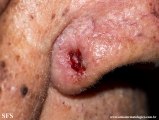 basal cell carcinoma