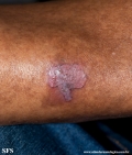 basal cell carcinoma