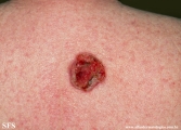 basal cell carcinoma