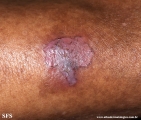 basal cell carcinoma