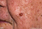 basal cell carcinoma