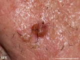 basal cell carcinoma
