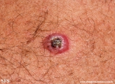 basal cell carcinoma