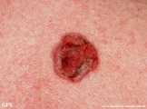 basal cell carcinoma
