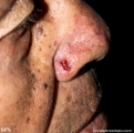 basal cell carcinoma