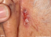 basal cell carcinoma