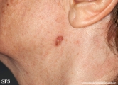 basal cell carcinoma