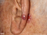 basal cell carcinoma