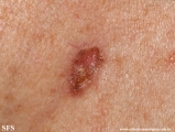 basal cell carcinoma