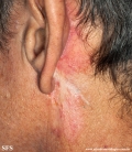 basal cell carcinoma