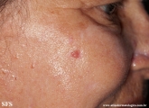 basal cell carcinoma
