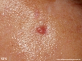 basal cell carcinoma