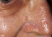 basal cell carcinoma