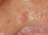 basal cell carcinoma