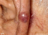basal cell carcinoma