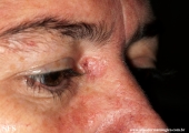 basal cell carcinoma