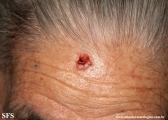 basal cell carcinoma