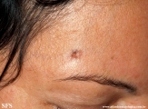 basal cell carcinoma