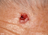 basal cell carcinoma