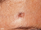 basal cell carcinoma