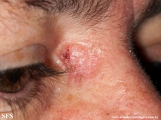 basal cell carcinoma