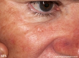 basal cell carcinoma