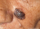 basal cell carcinoma