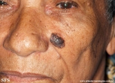 basal cell carcinoma