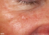 basal cell carcinoma