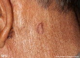 basal cell carcinoma