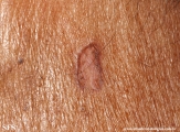 basal cell carcinoma