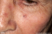 basal cell carcinoma