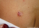 basal cell carcinoma