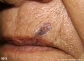 basal cell carcinoma
